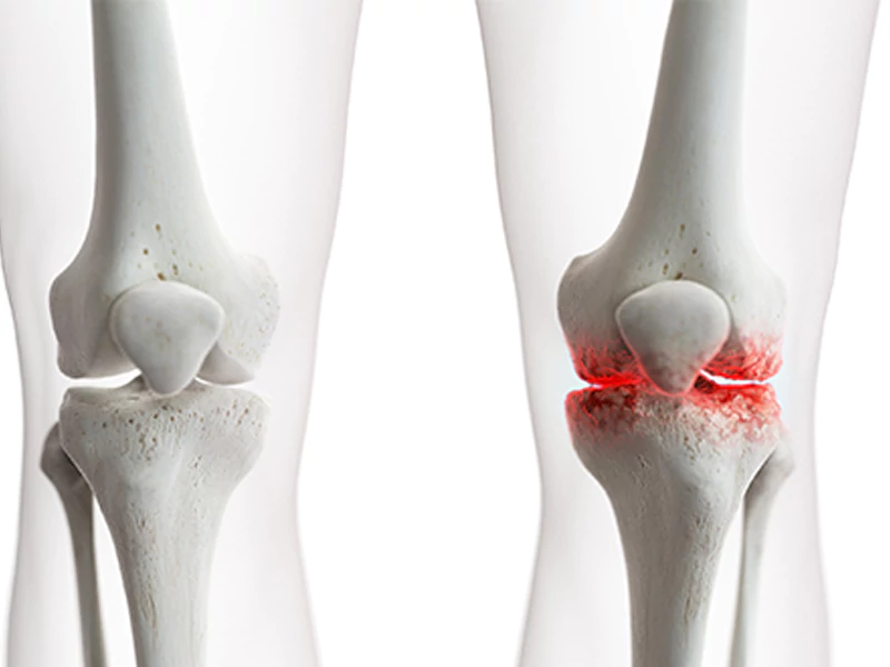 علائم آرتروز زانو