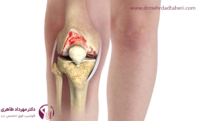 علائم و نشانه‌های آرتروز زانو