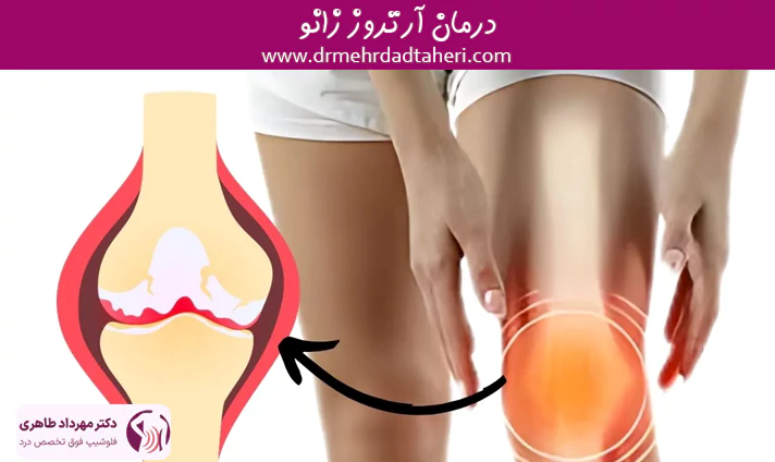 درمان-قطعی-آرتروز-زانو